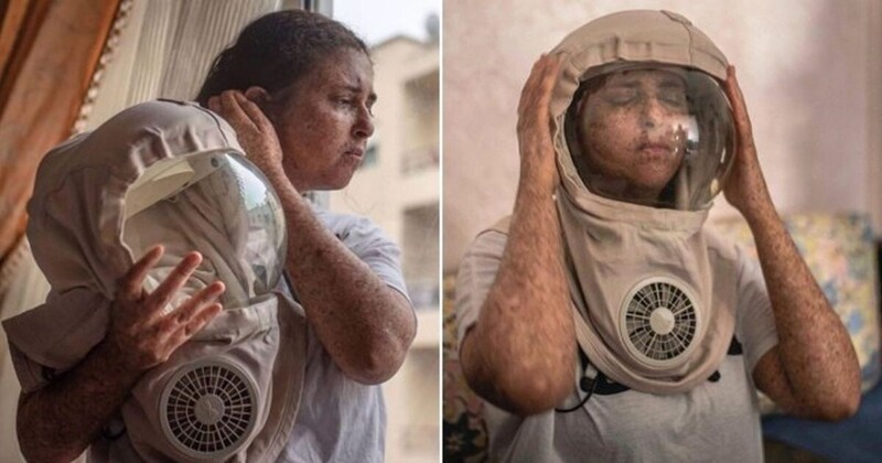 Женщина с аллергией на солнце не выходит на улицу без маски уже двадцать лет (3 фото)