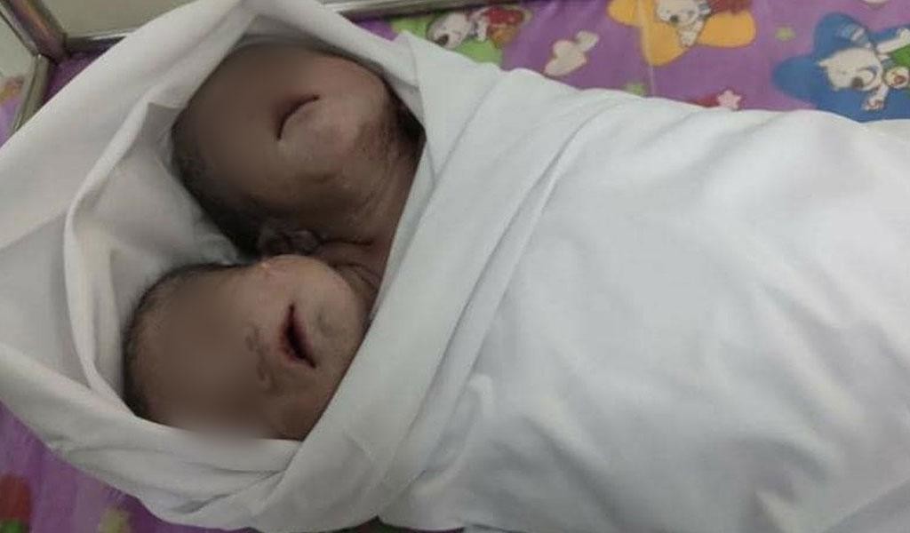 В Азии родился здоровый двуглавый малыш (4 фото)