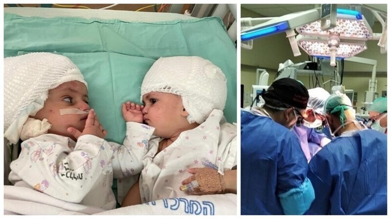 В Израиле провели уникальную операцию по разделению сиамских близнецов (10 фото + 1 видео)