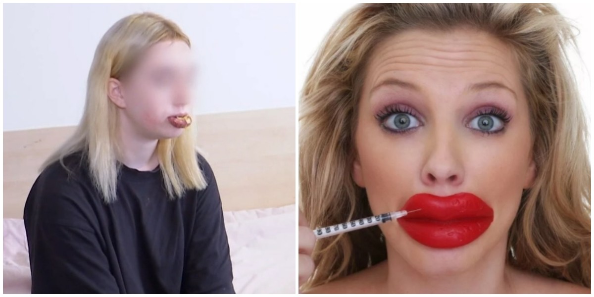 Лайфхак из интернета: 14-летняя девочка решила увеличить губы и сама вколола себе косметическое масло (2 фото)